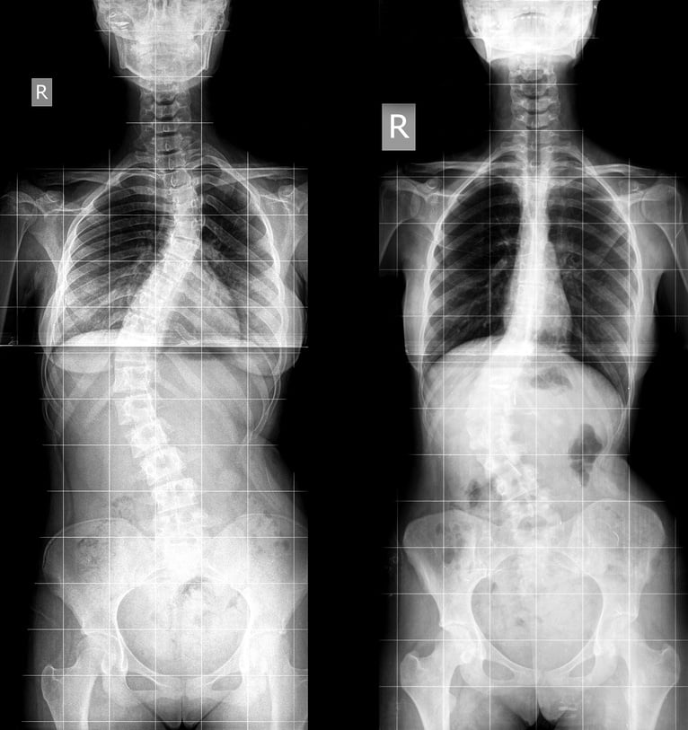 Scoliosis X-ray image